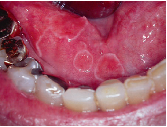 Geographic Tongue (1) | Dentistry & Medicine